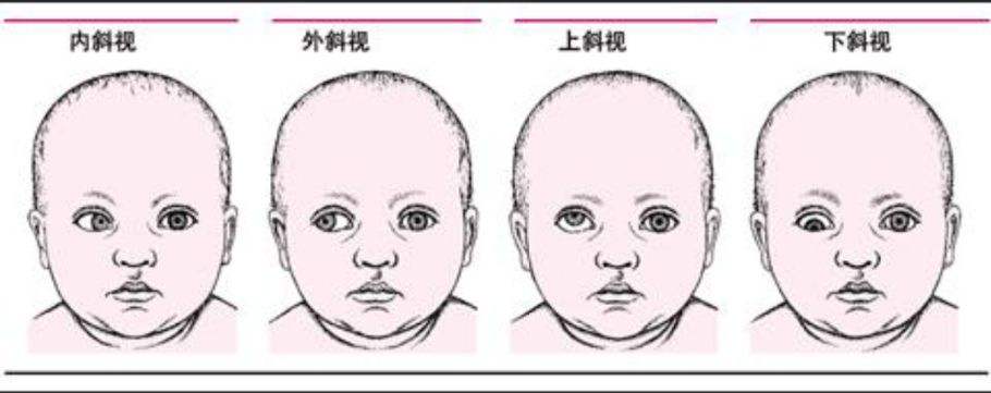 治疗斜弱视的方法