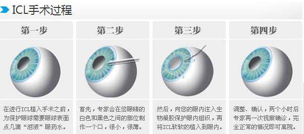 贵阳 近视眼手术