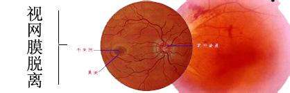 视网膜脱落的原因有哪些？