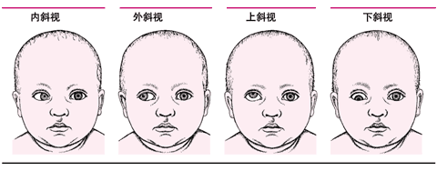 间歇性外斜视怎么矫正？