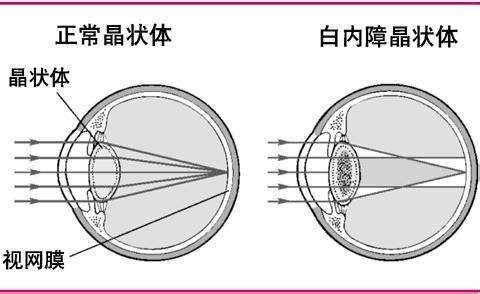 白内障可以非手术治疗吗?