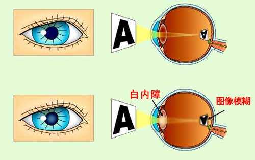 贵州治疗白内障无需等待