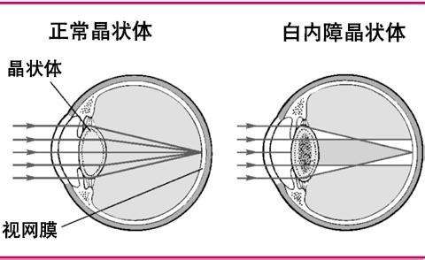 白内障手术应该在什么时候做比较好？