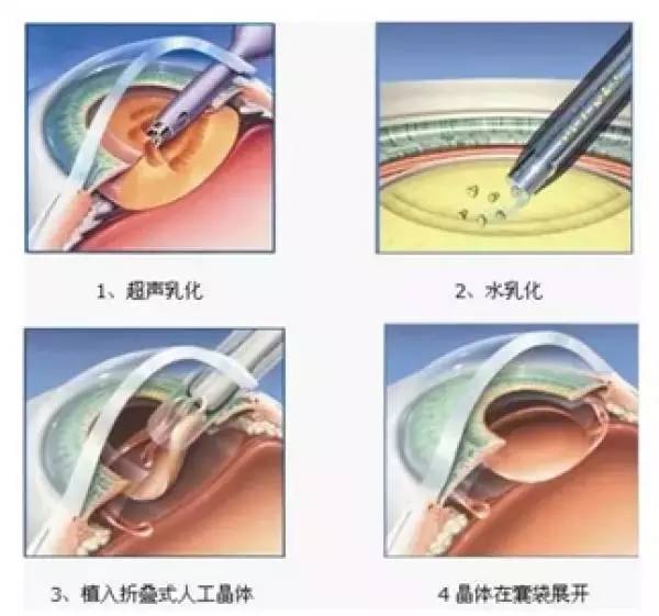 用眼药水可以治疗白内障吗？