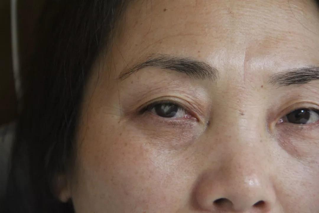 20年角膜白斑等待，今朝“点亮光明之爱”