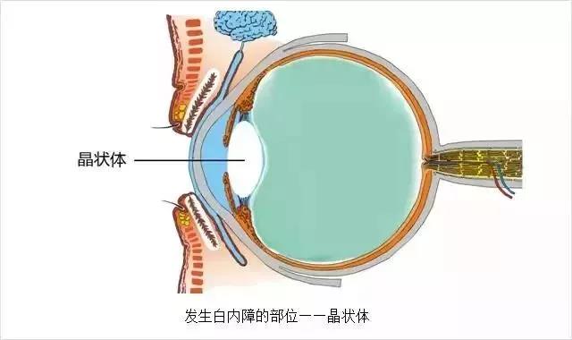 白内障，不治疗会失明吗？