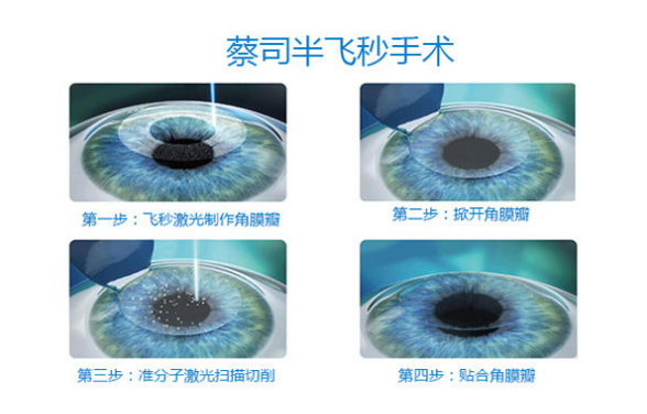 在普瑞眼科，完成你的摘镜梦想！