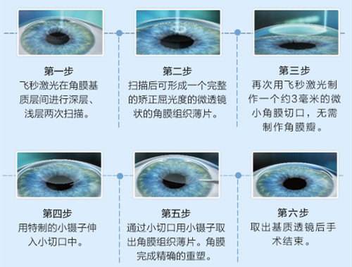 贵阳全飞秒激光近视手术价格