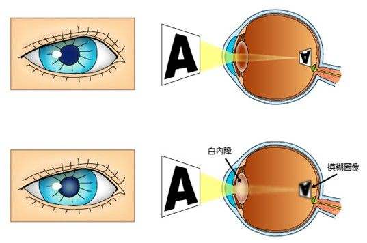 关于白内障您需要知道这些问题