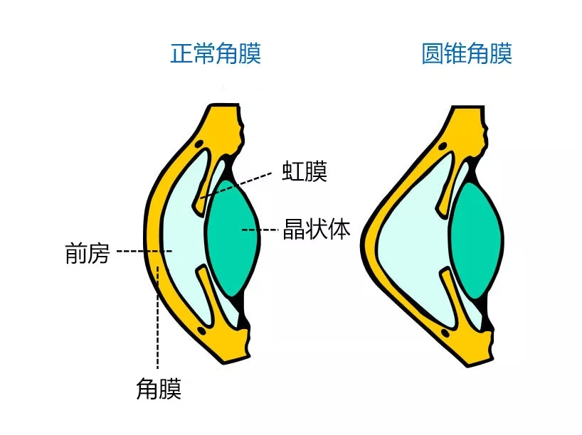角膜病不容小觑！ 我院一天内成功完成3例角膜移植手术