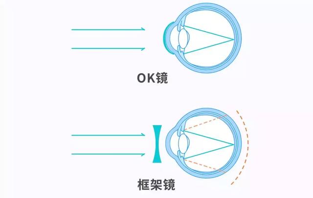 OK镜的定期复查，能不能少做几次？