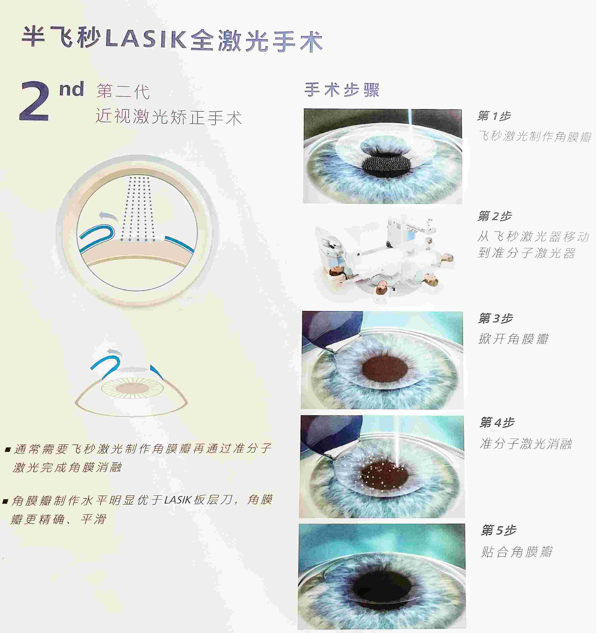 近视手术方式│半飞秒