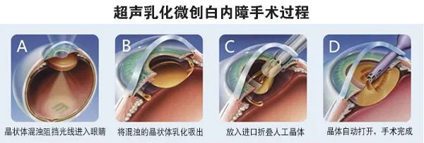 白内障手术为什么要植入人工晶体？